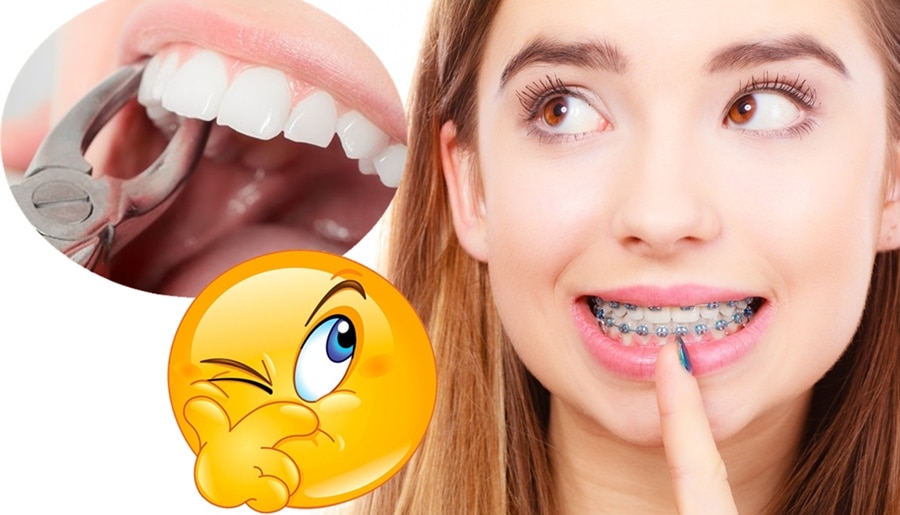 ¿Por qué a veces es necesario hacer extracciones de dientes en ortodoncia?