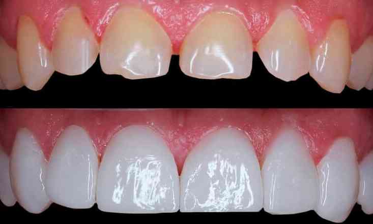 Ortodoncia o Carillas Dentales