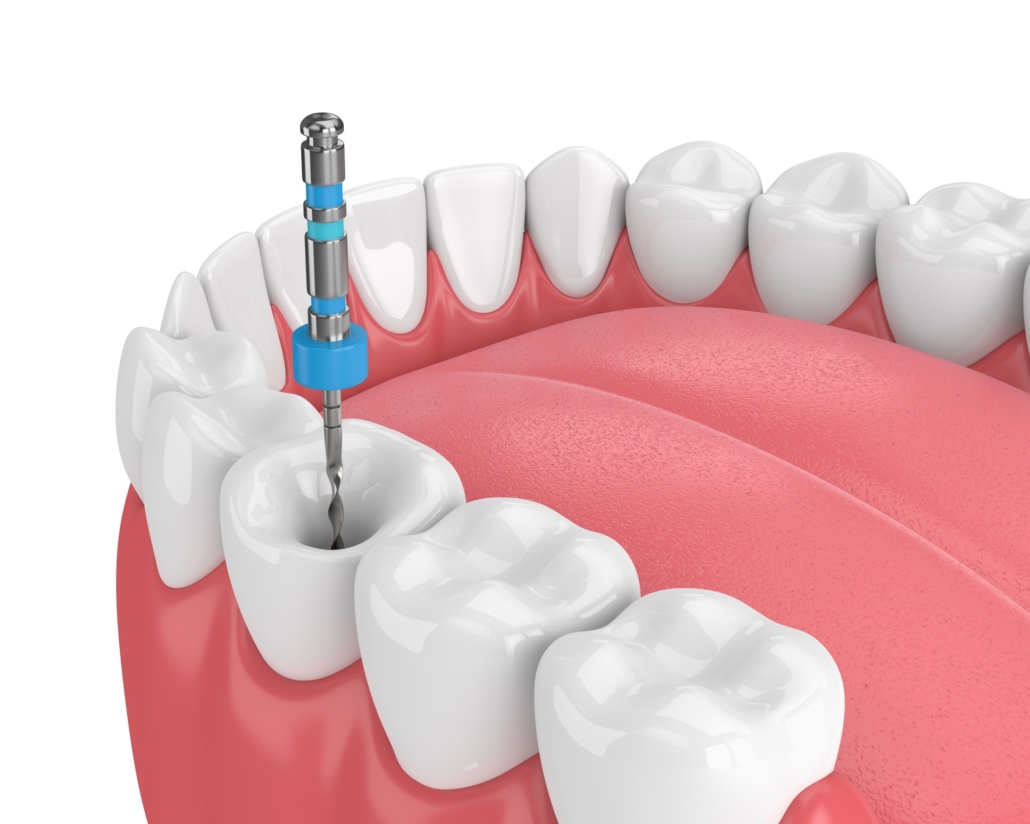 ¿Cuándo es necesaria una endodoncia?