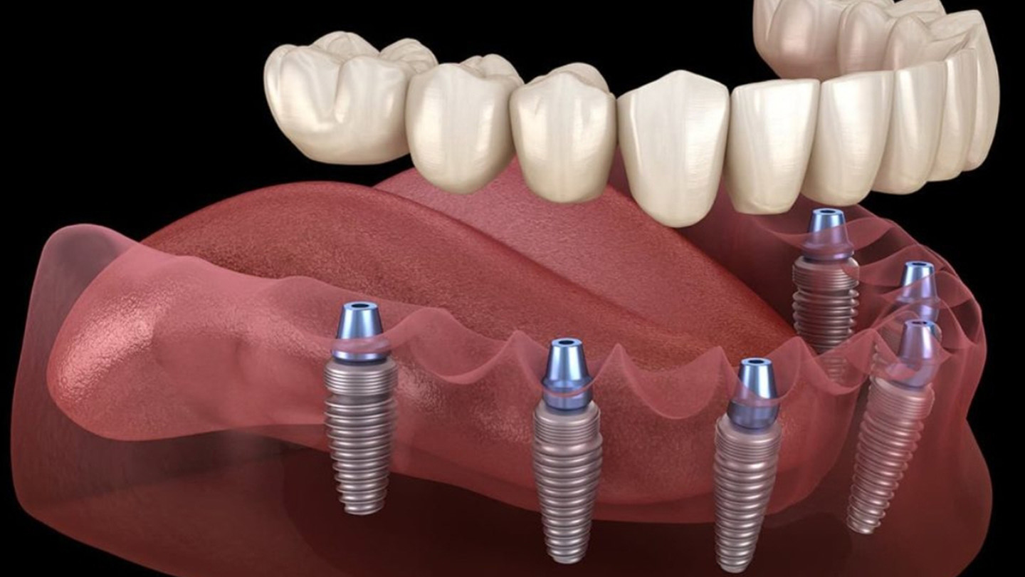 Implantes Dentales, Prótesis fijas