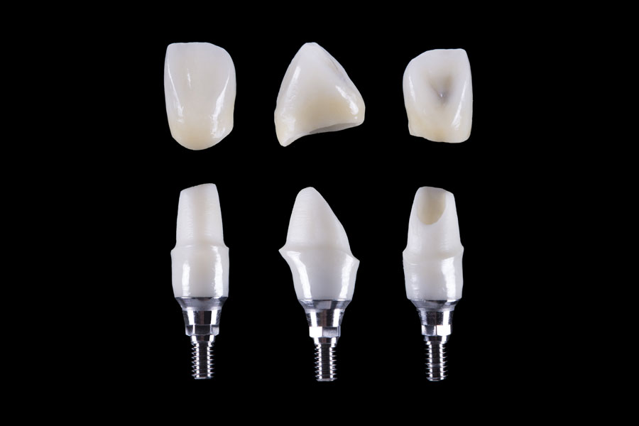 Corona sobre Implante dental