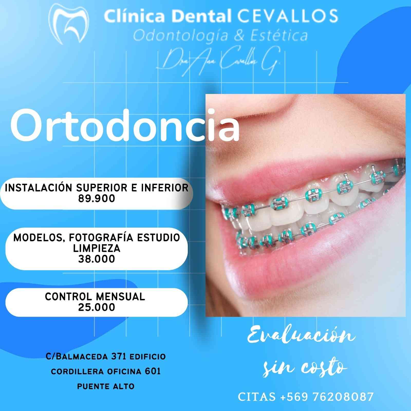 Ortodoncia Metálica Convencional
